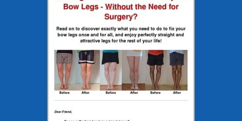 Bow Legs No More – Hot For Year 2018!