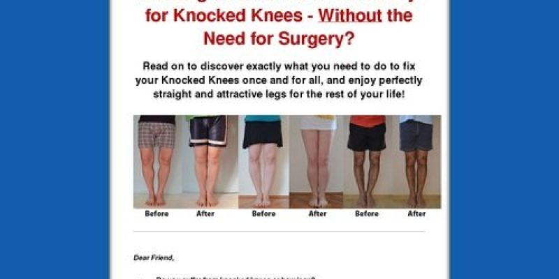 Knocked Knees No More – How to Straighten Your Legs Without Surgery!